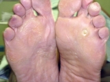 La hiperqueratosis