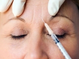 Botox: 9 preguntas, 9 respuestas